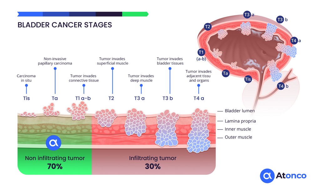 Stages of bladder cancer