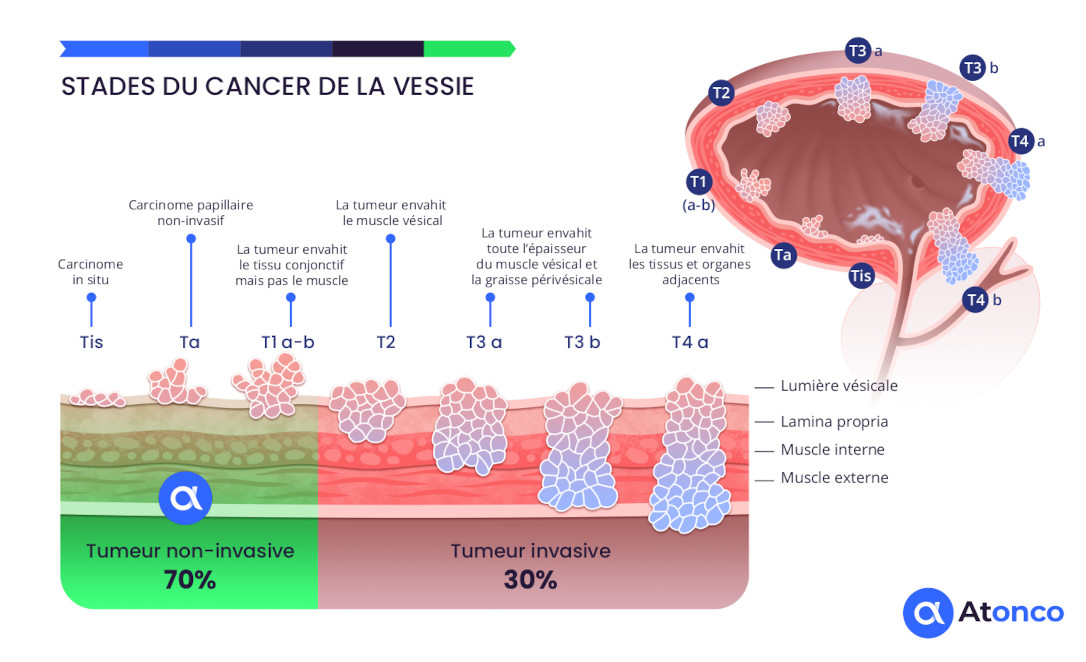 Stades du cancer de la vessie