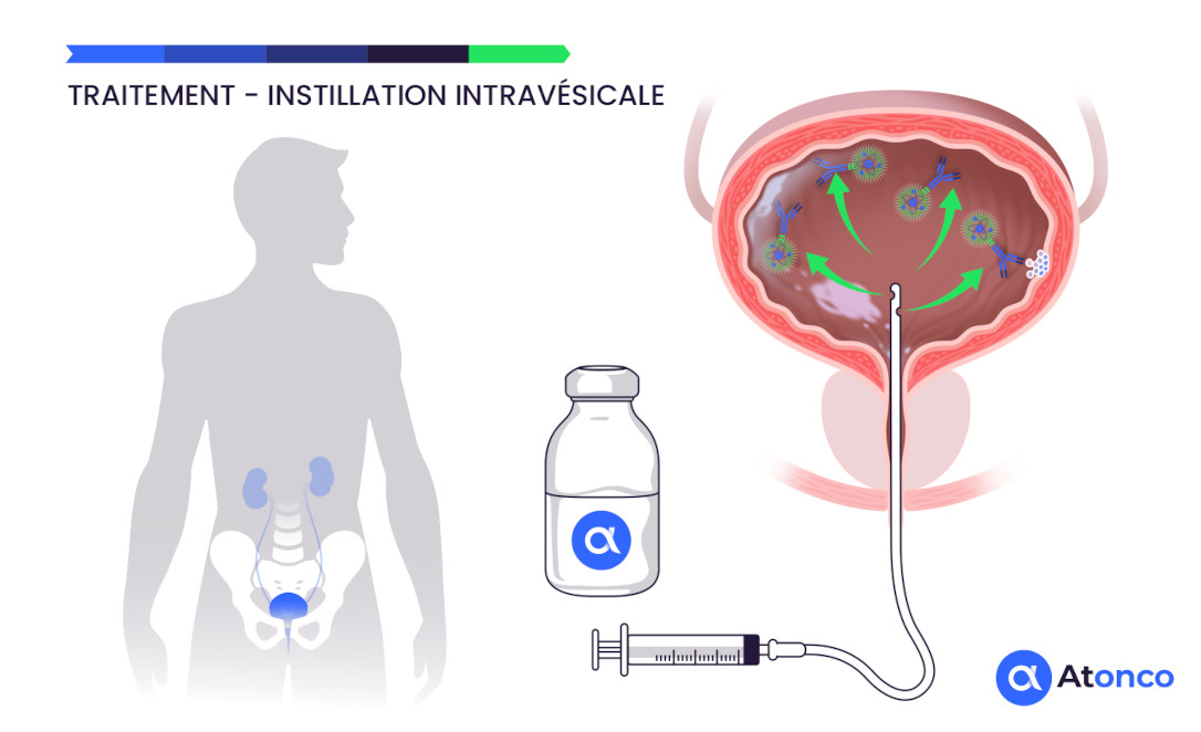 Traitement par instillation intravésicale
