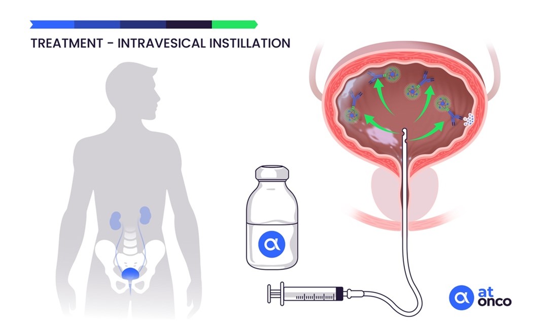 Treatment by intravesical instillation